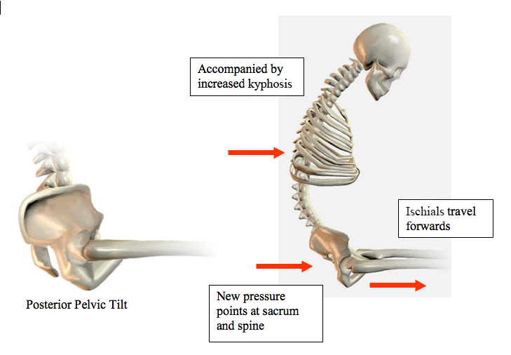 Posterior pelvic tilt. Accompanied by increased kyphosis. Ischials travel forwards. New pressure points at sacrum and spine.