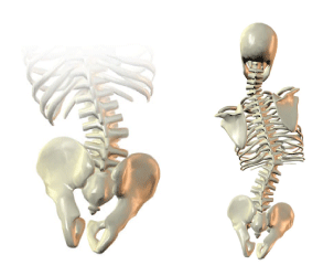 Right obliquity compensating scoliosis